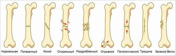 Типы переломов костей